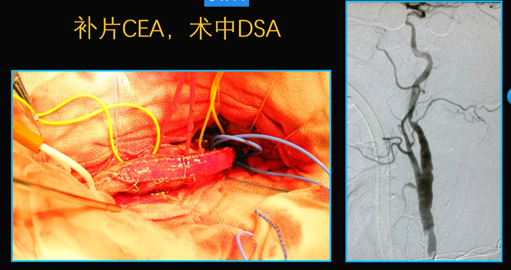 为什么手术会用到结扎夹佟志勇：高位CEA手术要点_https://www.jmylbn.com_新闻资讯_第9张