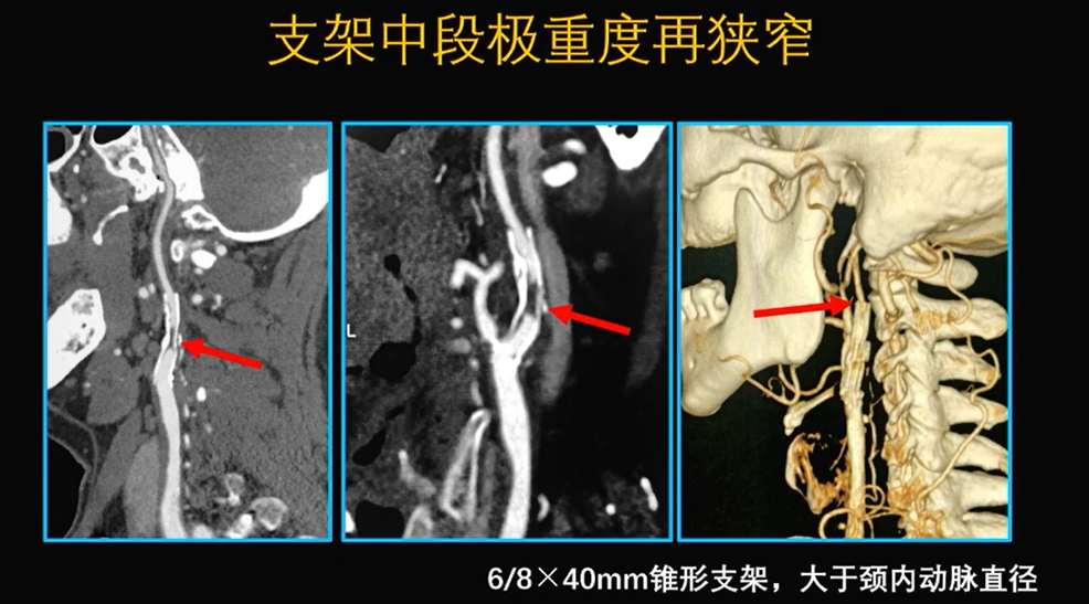 为什么手术会用到结扎夹佟志勇：高位CEA手术要点_https://www.jmylbn.com_新闻资讯_第10张