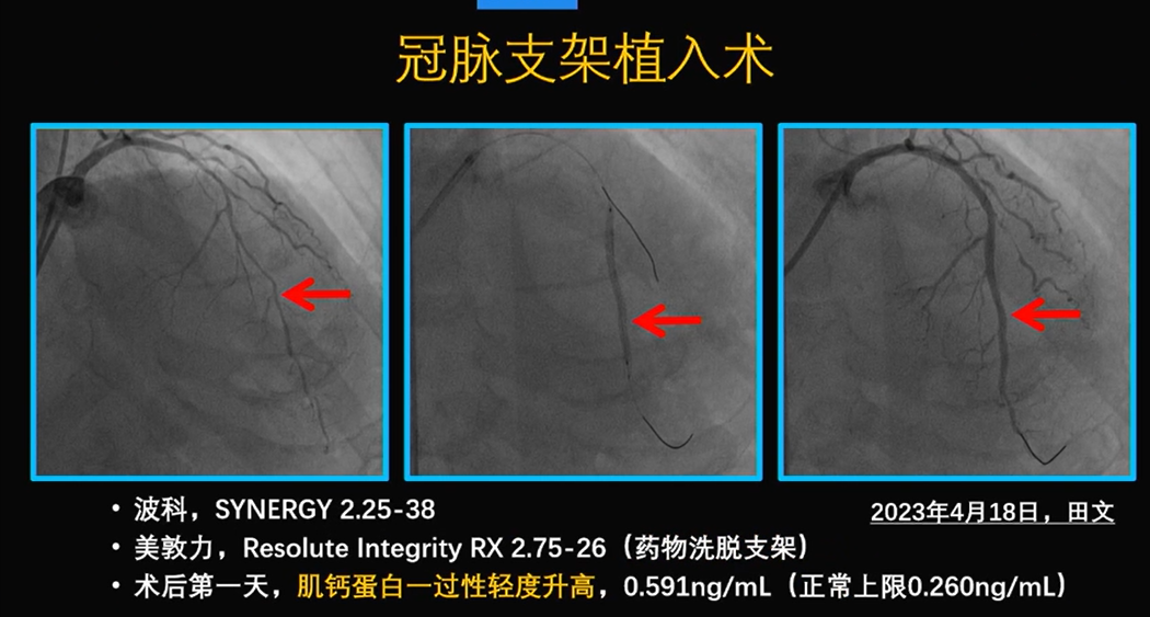 为什么手术会用到结扎夹佟志勇：高位CEA手术要点_https://www.jmylbn.com_新闻资讯_第16张