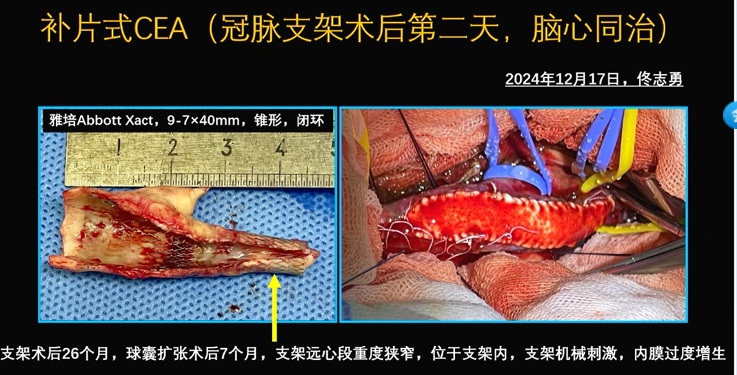 为什么手术会用到结扎夹佟志勇：高位CEA手术要点_https://www.jmylbn.com_新闻资讯_第5张