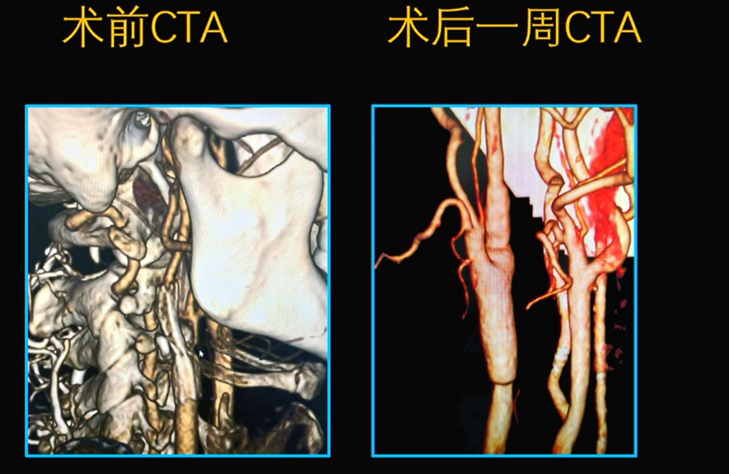为什么手术会用到结扎夹佟志勇：高位CEA手术要点_https://www.jmylbn.com_新闻资讯_第14张