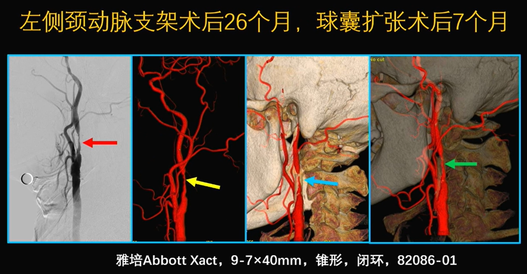 为什么手术会用到结扎夹佟志勇：高位CEA手术要点_https://www.jmylbn.com_新闻资讯_第3张