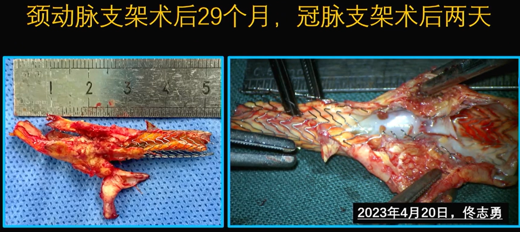 为什么手术会用到结扎夹佟志勇：高位CEA手术要点_https://www.jmylbn.com_新闻资讯_第17张