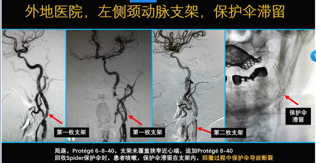 为什么手术会用到结扎夹佟志勇：高位CEA手术要点_https://www.jmylbn.com_新闻资讯_第6张