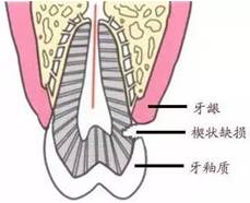 一個刷牙好習慣，害她22顆牙全壞！可怕的是很多人每天都在做 健康 第4張