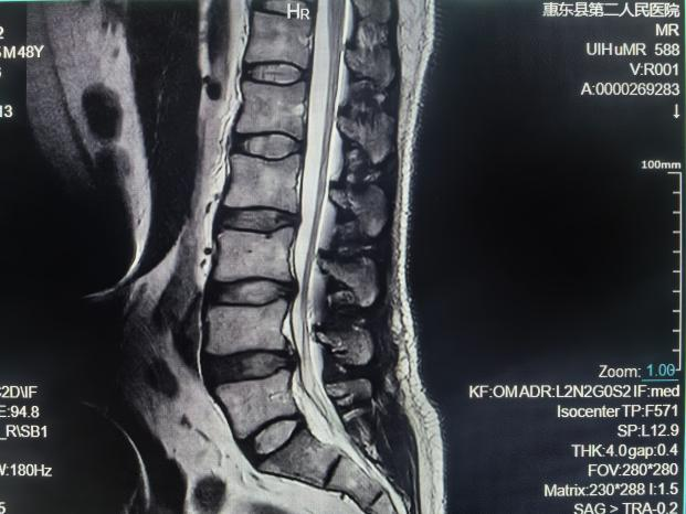 联影的磁共振怎么样号外！号外！！惠东县第二人民医院引进联影1.5T磁共振设备_https://www.jmylbn.com_新闻资讯_第14张