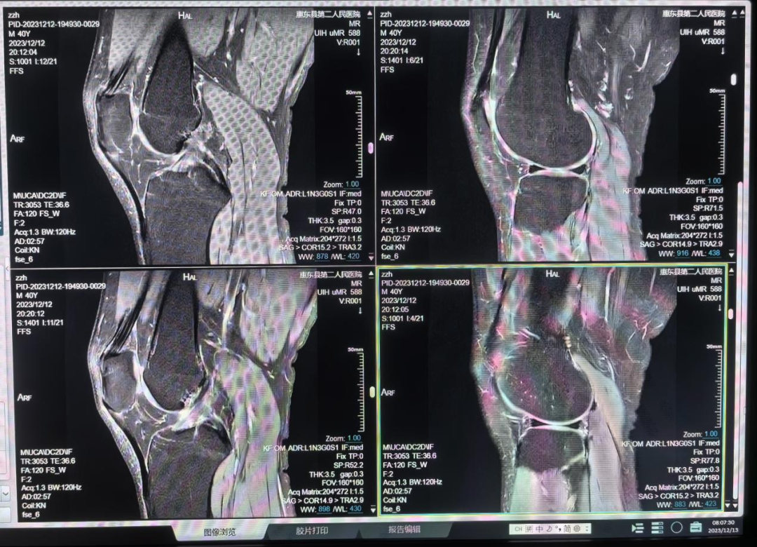 联影的磁共振怎么样号外！号外！！惠东县第二人民医院引进联影1.5T磁共振设备_https://www.jmylbn.com_新闻资讯_第15张