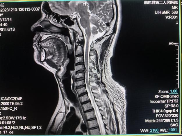联影的磁共振怎么样号外！号外！！惠东县第二人民医院引进联影1.5T磁共振设备_https://www.jmylbn.com_新闻资讯_第13张