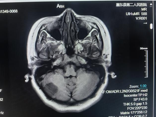 联影的磁共振怎么样号外！号外！！惠东县第二人民医院引进联影1.5T磁共振设备_https://www.jmylbn.com_新闻资讯_第5张