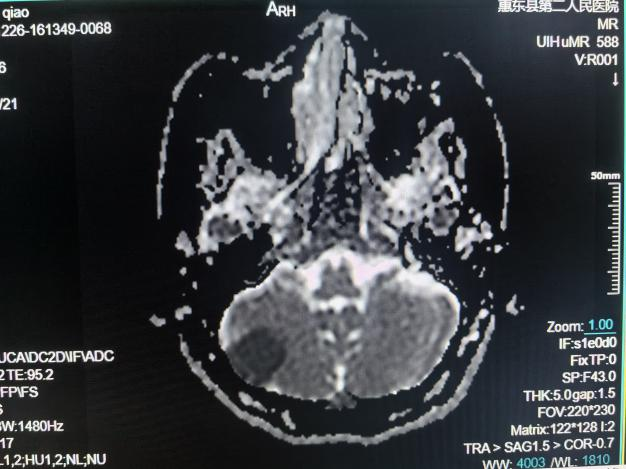 联影的磁共振怎么样号外！号外！！惠东县第二人民医院引进联影1.5T磁共振设备_https://www.jmylbn.com_新闻资讯_第8张