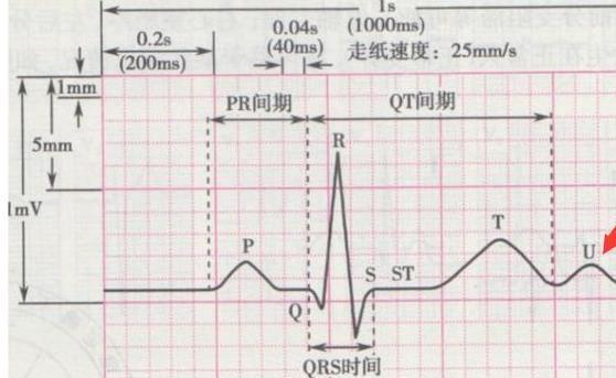 心电图机怎么看【科普】心电图怎么看？点进来带你认识心电图_https://www.jmylbn.com_新闻资讯_第13张