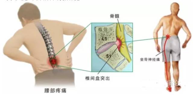 乾貨 | 腰腿痛診斷思維 健康 第8張