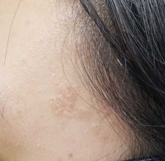 光子治疗仪有什么效果富医技术丨浅谈光子治疗_https://www.jmylbn.com_新闻资讯_第9张