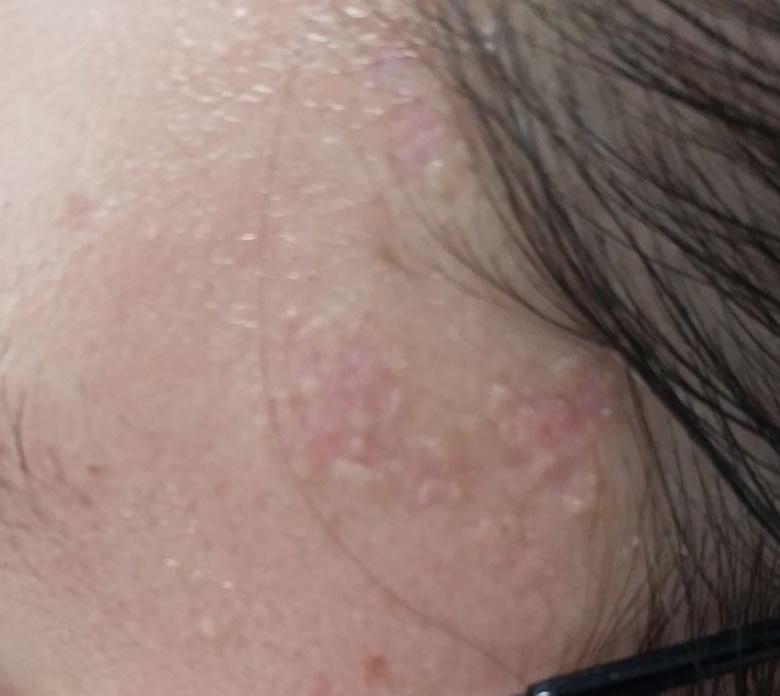 光子治疗仪有什么效果富医技术丨浅谈光子治疗_https://www.jmylbn.com_新闻资讯_第8张