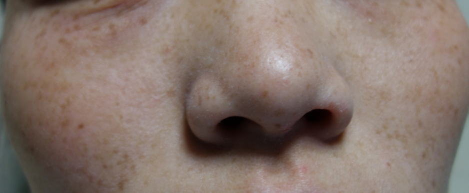 光子治疗仪有什么效果富医技术丨浅谈光子治疗_https://www.jmylbn.com_新闻资讯_第4张