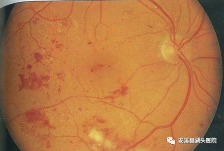 眼底照相有什么用【“视”关重要】眼底一张照，眼病早知道！_https://www.jmylbn.com_新闻资讯_第9张