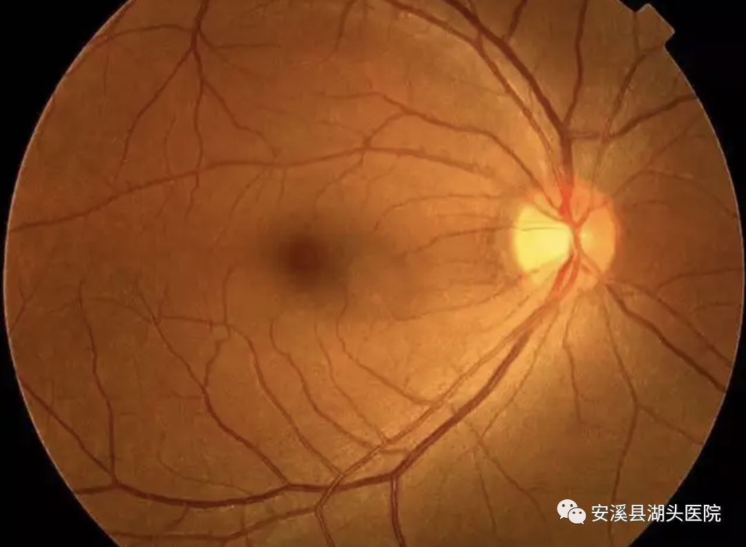 眼底照相有什么用【“视”关重要】眼底一张照，眼病早知道！_https://www.jmylbn.com_新闻资讯_第5张