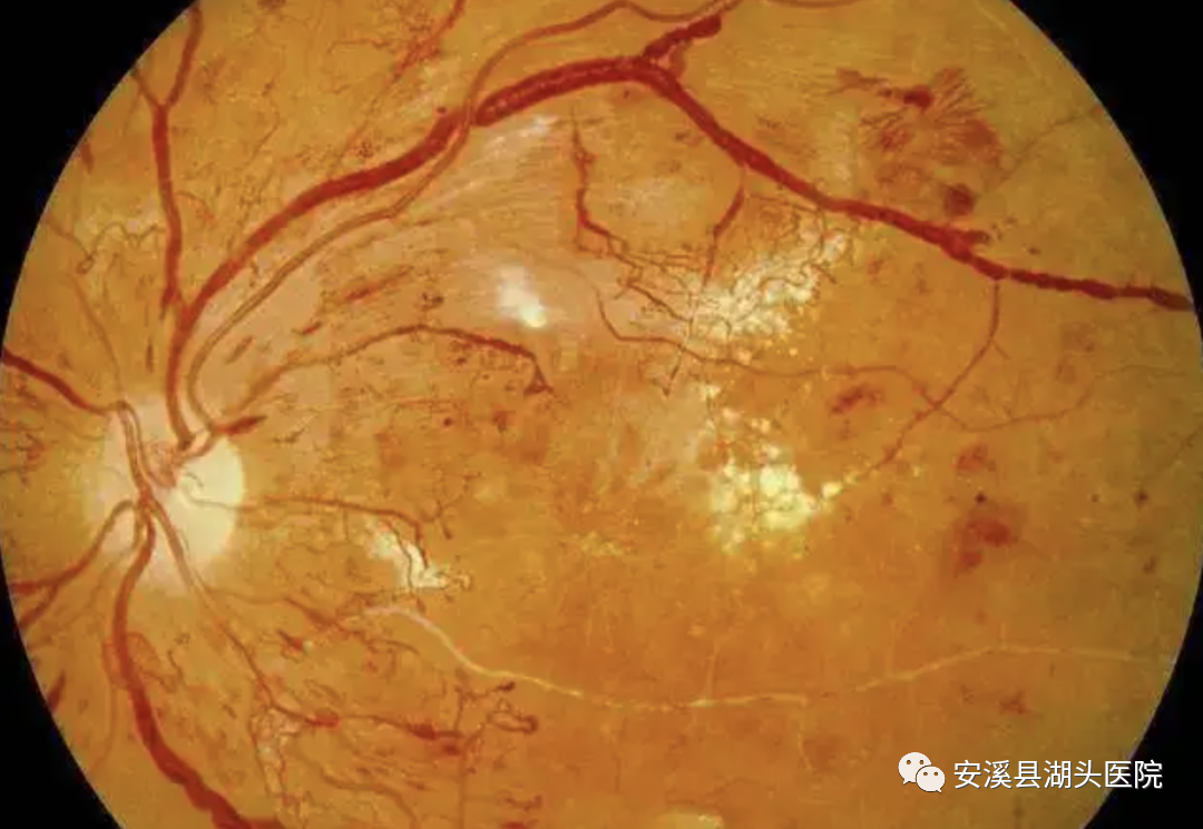 眼底照相有什么用【“视”关重要】眼底一张照，眼病早知道！_https://www.jmylbn.com_新闻资讯_第10张