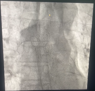 C臂透视怎么实现我院成功开展首例 C 臂透视下食管内支架植入术_https://www.jmylbn.com_新闻资讯_第1张