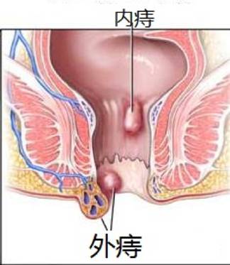 大便就像拉圖釘......痔瘡是一種說不出的痛！ 健康 第6張