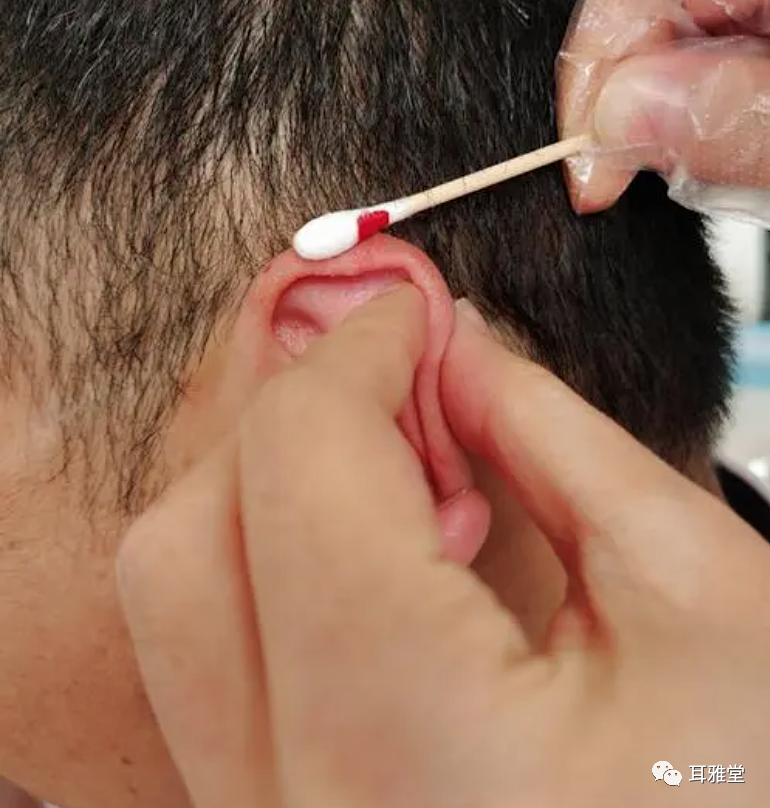 华佗磁疗贴怎么样耳穴放血联合耳穴磁疗对小儿多发性抽动症疗效果显著_https://www.jmylbn.com_新闻资讯_第4张