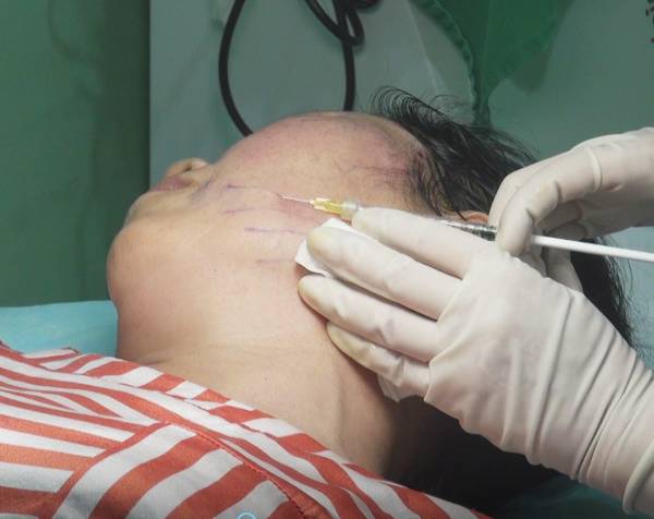 全面部ppdo埋线提升超详细步骤图解