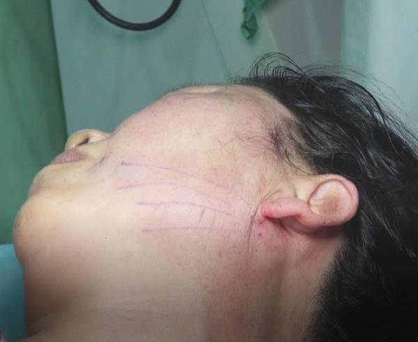 全面部ppdo埋线提升超详细步骤图解