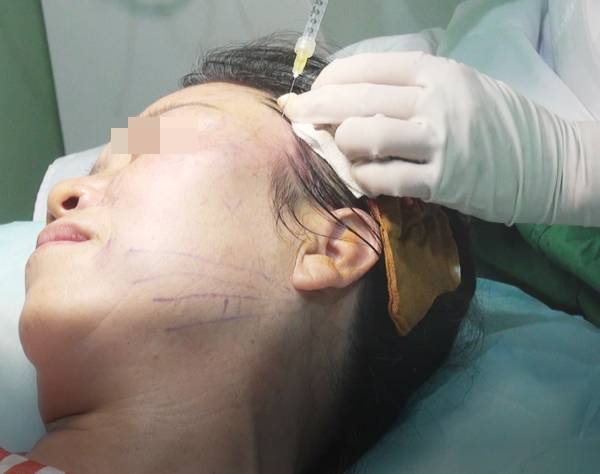 全面部ppdo埋线提升超详细步骤图解