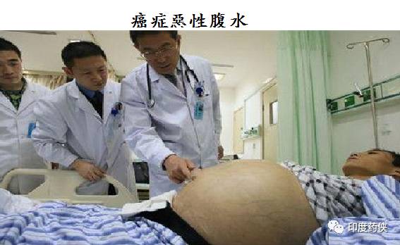 67癌症恶性腹水之处理