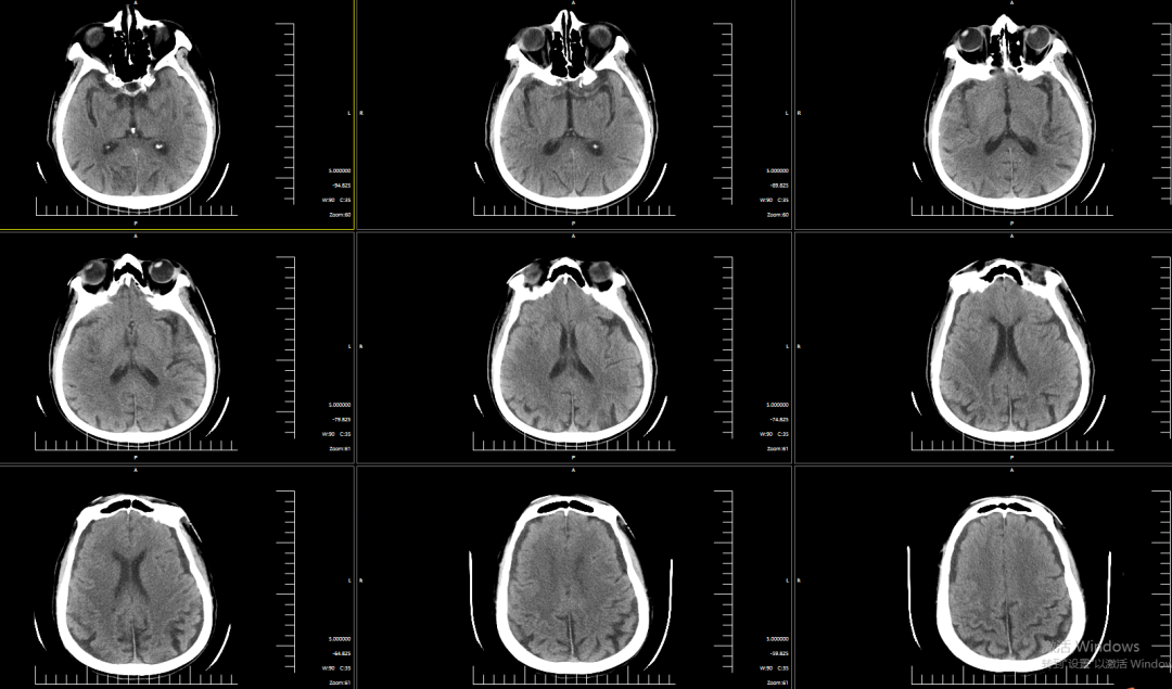 动脉长鞘怎么置入有励可说｜Locaste 088励楷长鞘及Tarvos微导丝在右侧大脑中动脉M2段取栓术中的应用_https://www.jmylbn.com_新闻资讯_第4张