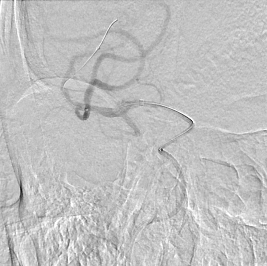 动脉长鞘怎么置入有励可说｜Locaste 088励楷长鞘及Tarvos微导丝在右侧大脑中动脉M2段取栓术中的应用_https://www.jmylbn.com_新闻资讯_第15张