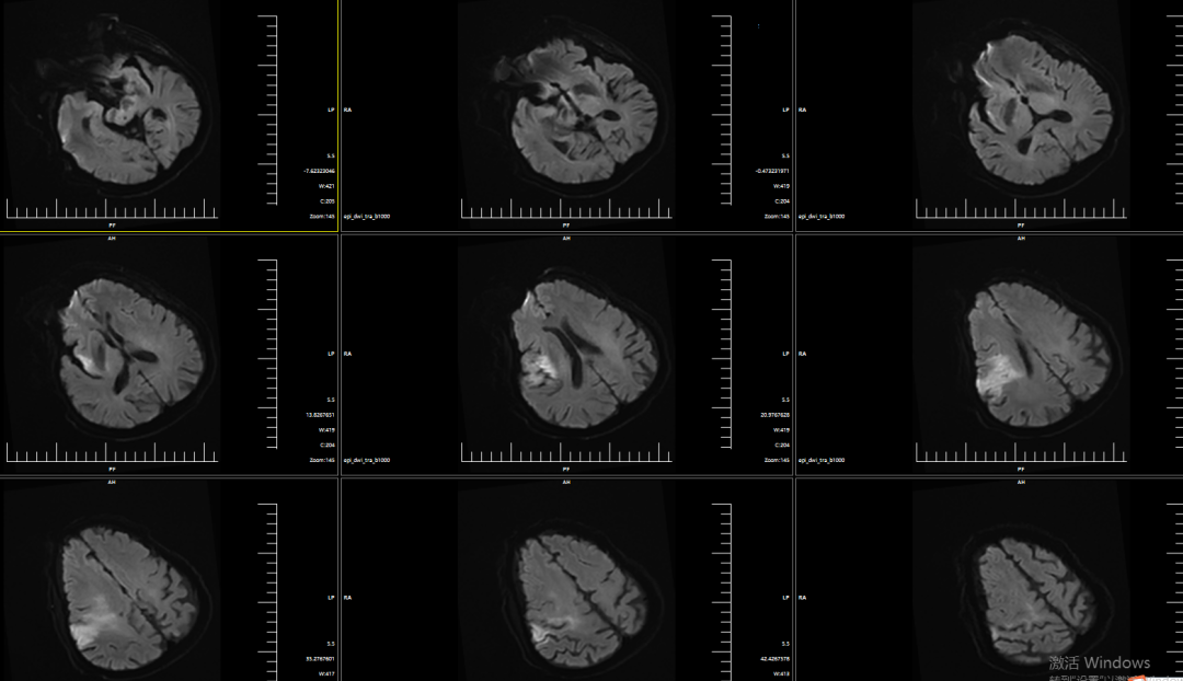 动脉长鞘怎么置入有励可说｜Locaste 088励楷长鞘及Tarvos微导丝在右侧大脑中动脉M2段取栓术中的应用_https://www.jmylbn.com_新闻资讯_第5张