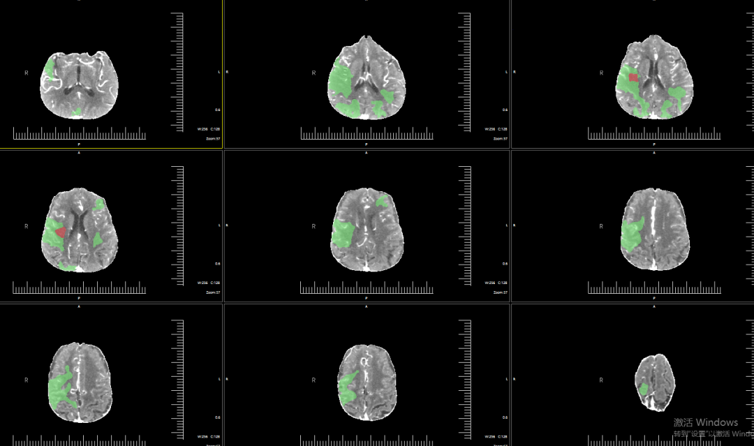 动脉长鞘怎么置入有励可说｜Locaste 088励楷长鞘及Tarvos微导丝在右侧大脑中动脉M2段取栓术中的应用_https://www.jmylbn.com_新闻资讯_第9张
