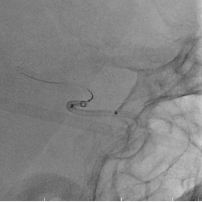 动脉长鞘怎么置入有励可说｜Locaste 088励楷长鞘及Tarvos微导丝在右侧大脑中动脉M2段取栓术中的应用_https://www.jmylbn.com_新闻资讯_第18张