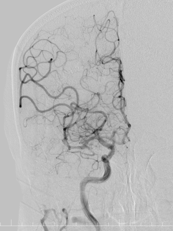 动脉长鞘怎么置入有励可说｜Locaste 088励楷长鞘及Tarvos微导丝在右侧大脑中动脉M2段取栓术中的应用_https://www.jmylbn.com_新闻资讯_第10张