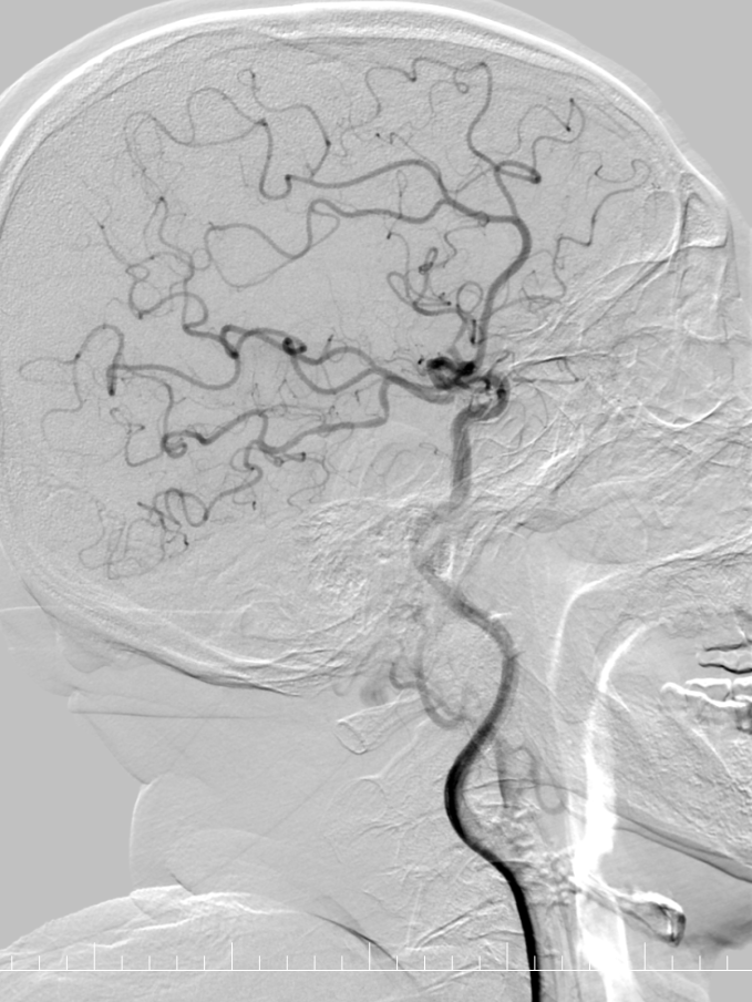 动脉长鞘怎么置入有励可说｜Locaste 088励楷长鞘及Tarvos微导丝在右侧大脑中动脉M2段取栓术中的应用_https://www.jmylbn.com_新闻资讯_第11张