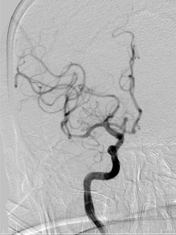 动脉长鞘怎么置入有励可说｜Locaste 088励楷长鞘及Tarvos微导丝在右侧大脑中动脉M2段取栓术中的应用_https://www.jmylbn.com_新闻资讯_第20张