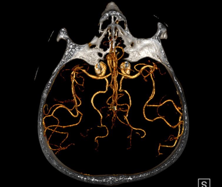 动脉长鞘怎么置入有励可说｜Locaste 088励楷长鞘及Tarvos微导丝在右侧大脑中动脉M2段取栓术中的应用_https://www.jmylbn.com_新闻资讯_第8张
