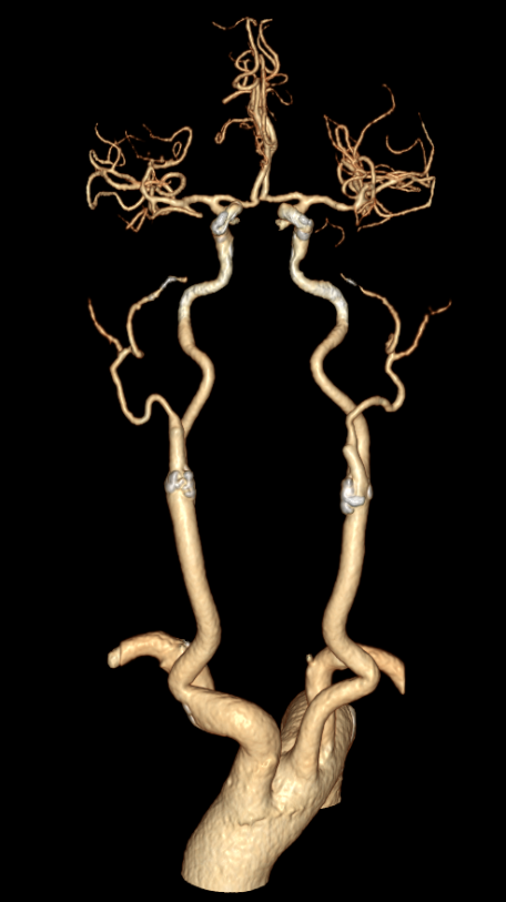 动脉长鞘怎么置入有励可说｜Locaste 088励楷长鞘及Tarvos微导丝在右侧大脑中动脉M2段取栓术中的应用_https://www.jmylbn.com_新闻资讯_第6张