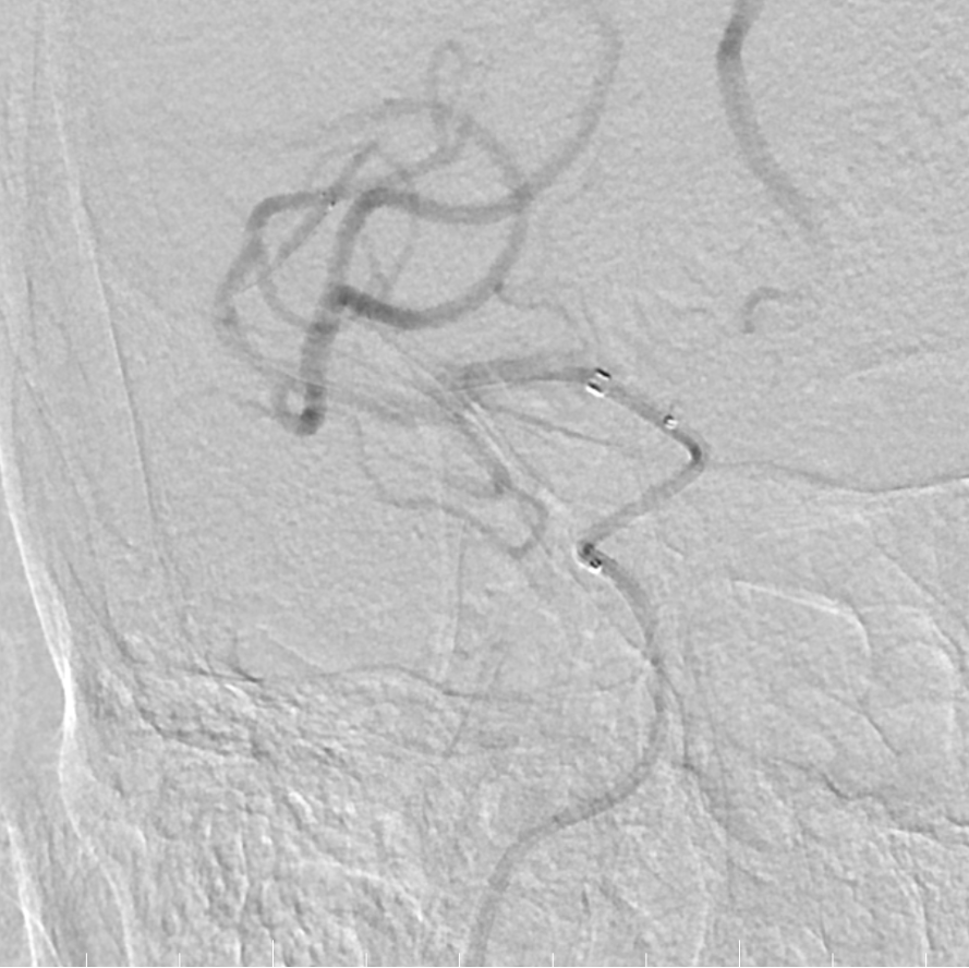 动脉长鞘怎么置入有励可说｜Locaste 088励楷长鞘及Tarvos微导丝在右侧大脑中动脉M2段取栓术中的应用_https://www.jmylbn.com_新闻资讯_第19张