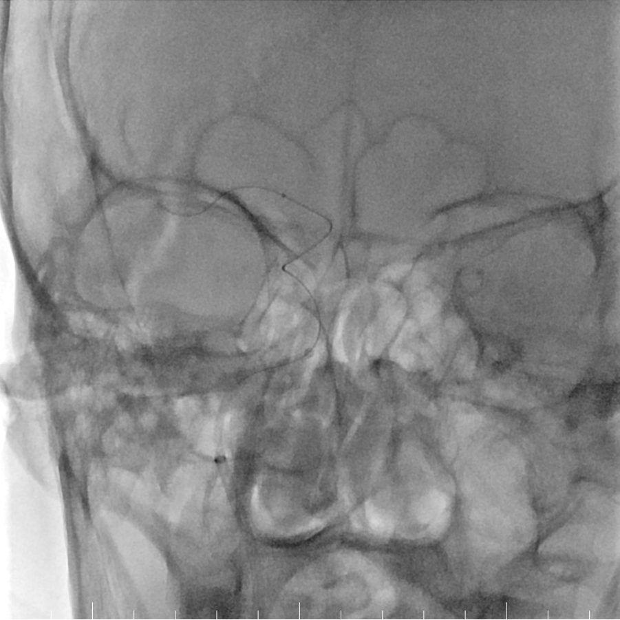 动脉长鞘怎么置入有励可说｜Locaste 088励楷长鞘及Tarvos微导丝在右侧大脑中动脉M2段取栓术中的应用_https://www.jmylbn.com_新闻资讯_第12张