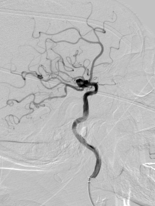 动脉长鞘怎么置入有励可说｜Locaste 088励楷长鞘及Tarvos微导丝在右侧大脑中动脉M2段取栓术中的应用_https://www.jmylbn.com_新闻资讯_第21张