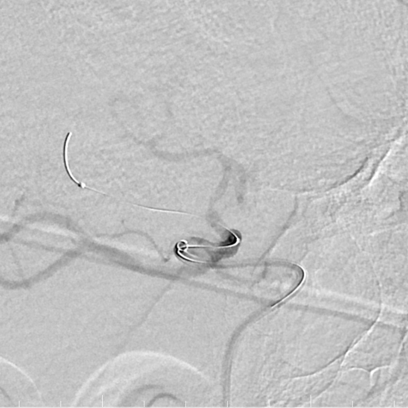 动脉长鞘怎么置入有励可说｜Locaste 088励楷长鞘及Tarvos微导丝在右侧大脑中动脉M2段取栓术中的应用_https://www.jmylbn.com_新闻资讯_第14张