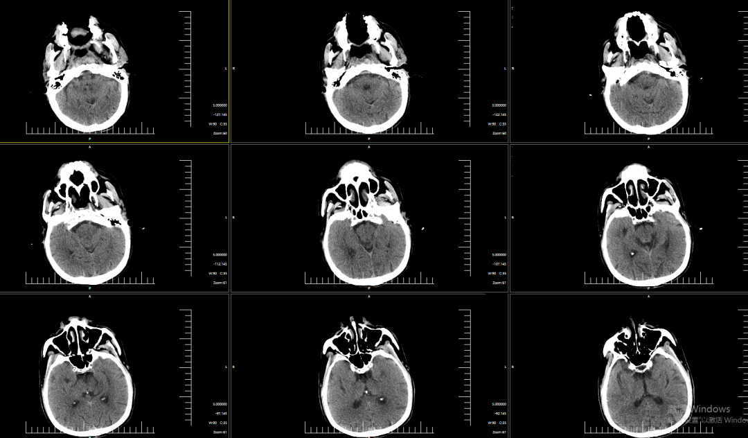 动脉长鞘怎么置入有励可说｜Locaste 088励楷长鞘及Tarvos微导丝在右侧大脑中动脉M2段取栓术中的应用_https://www.jmylbn.com_新闻资讯_第22张