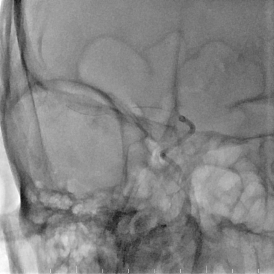 动脉长鞘怎么置入有励可说｜Locaste 088励楷长鞘及Tarvos微导丝在右侧大脑中动脉M2段取栓术中的应用_https://www.jmylbn.com_新闻资讯_第13张