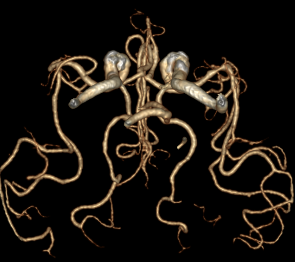 动脉长鞘怎么置入有励可说｜Locaste 088励楷长鞘及Tarvos微导丝在右侧大脑中动脉M2段取栓术中的应用_https://www.jmylbn.com_新闻资讯_第7张