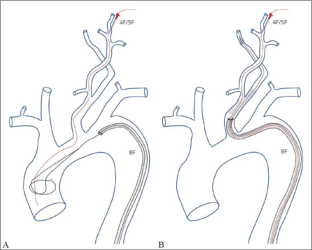 泥鳅导丝怎么用宣武CRC星期五｜CAS遇天堑，如何变通途？_https://www.jmylbn.com_新闻资讯_第10张