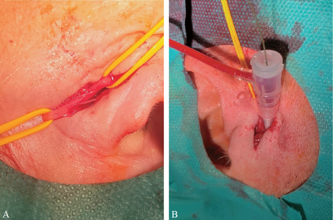 泥鳅导丝怎么用宣武CRC星期五｜CAS遇天堑，如何变通途？_https://www.jmylbn.com_新闻资讯_第9张