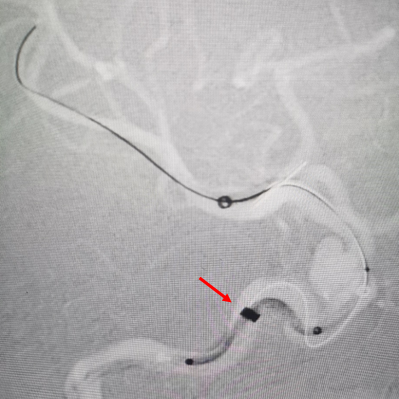 动脉长鞘怎么置入术说·第十七期丨Infinity长鞘助力Surpass Streamline血流导向密网支架治疗双侧颈内迂曲路径动脉瘤一例_https://www.jmylbn.com_新闻资讯_第24张