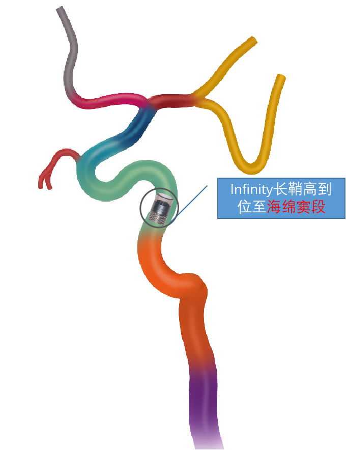 动脉长鞘怎么置入术说·第十七期丨Infinity长鞘助力Surpass Streamline血流导向密网支架治疗双侧颈内迂曲路径动脉瘤一例_https://www.jmylbn.com_新闻资讯_第19张